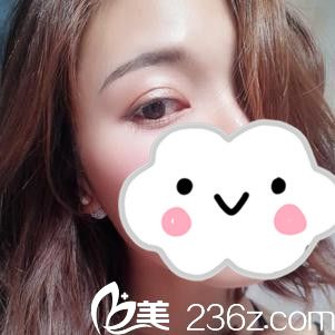 在贛州華美做雙眼皮39天了