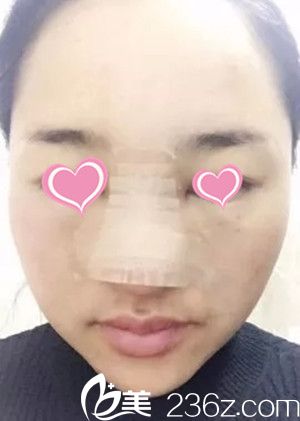  史希杰院長隆鼻手術案例分享