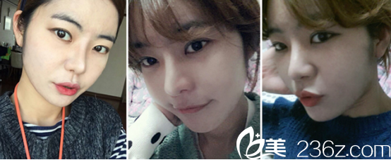 真是瞎了眼！韓國(guó)延世整形醫(yī)院雙眼皮對(duì)比韓國(guó)枓翰整形醫(yī)院全切雙眼皮+假體隆鼻如此驚艷，之前考慮的都是什么醫(yī)院