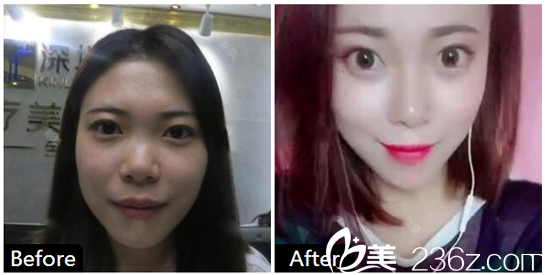 深圳健麗醫(yī)療美容醫(yī)院陳雪濤做的線雕隆鼻案例圖 深圳健麗醫(yī)療美容醫(yī)院陳雪濤做的線雕隆鼻案例圖