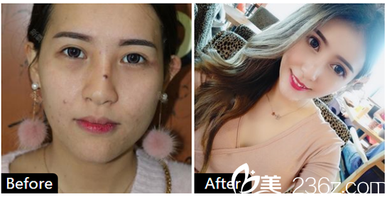 深圳健麗醫(yī)美陳雪濤全臉自體脂肪填充案例圖 深圳健麗醫(yī)美陳雪濤全臉自體脂肪填充案例圖