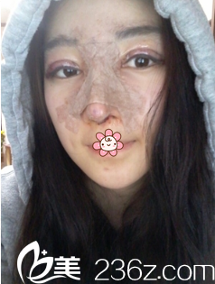 金智勛雙眼皮假體隆鼻術(shù)后6天