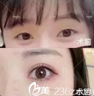 雙眼皮整形前后對比效果 雙眼皮整形前后對比效果