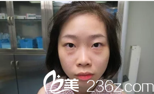 來深圳健麗醫(yī)療美容醫(yī)院祛眼袋前的照片 來深圳健麗醫(yī)療美容醫(yī)院祛眼袋前的照片