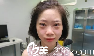 深圳健麗醫(yī)美陳雪濤不開刀祛眼袋和雙眼皮術(shù)后即刻效果圖 深圳健麗醫(yī)美陳雪濤不開刀祛眼袋和雙眼皮術(shù)后即刻效果圖