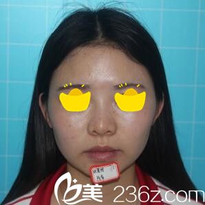 假體隆鼻術(shù)前照 假體隆鼻術(shù)前照