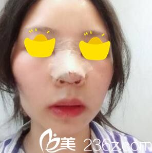 假體隆鼻手術(shù)當天效果 假體隆鼻手術(shù)當天效果