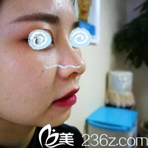 假體隆鼻第八天效果 假體隆鼻第八天效果