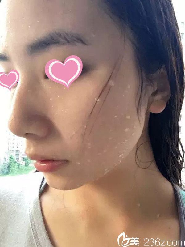 在<i data-id='f9756438-1d8e-4993-b3cb-c2a2468b6b6f' style='display:none;'></i>整形醫(yī)院祛痘后效果