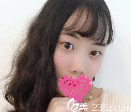 雙眼皮開眼角術(shù)前 雙眼皮開眼角術(shù)前