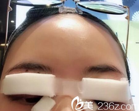 在濮陽張大夫整形做雙眼皮和開眼角 在濮陽張大夫整形做雙眼皮和開眼角