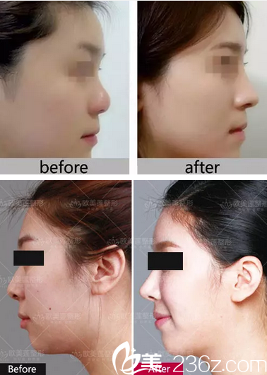 太原歐美蓮雷雪華鼻整形失敗修復(fù)效果對比圖