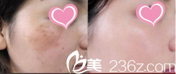 韓國(guó)S&U CLINIC整形醫(yī)院激光祛斑案例 韓國(guó)S&U CLINIC整形醫(yī)院激光祛斑案例