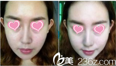 韓國(guó)S&U CLINIC整形醫(yī)院效果 韓國(guó)S&U CLINIC整形醫(yī)院效果