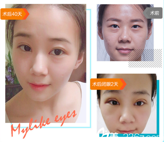 廣州美萊醫(yī)療美容整形醫(yī)院文科醫(yī)生雙眼皮開眼角案例圖片 廣州美萊醫(yī)療美容整形醫(yī)院文科醫(yī)生雙眼皮開眼角案例圖片