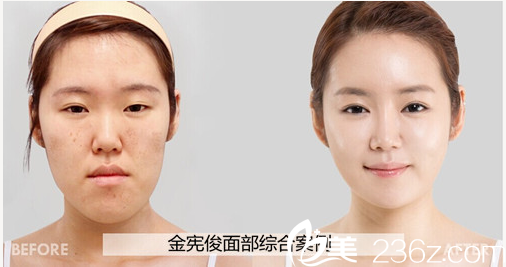 廣州美萊整形美容醫(yī)院金憲俊醫(yī)生面部綜合整形案例圖