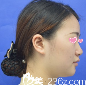 在韓國心美眼隆鼻術(shù)前照 在韓國心美眼隆鼻術(shù)前照