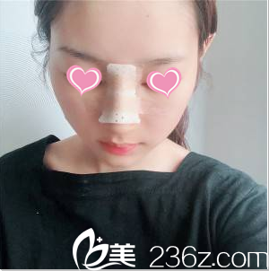 <!--<i data=20240703-sp></i>-->隆鼻案例術(shù)后4天效果 <!--<i data=20240703-sp></i>-->隆鼻案例術(shù)后4天效果