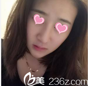 韓國心美眼<!--<i data=20240703-sp></i>-->鼻綜合案例 韓國心美眼<!--<i data=20240703-sp></i>-->鼻綜合案例