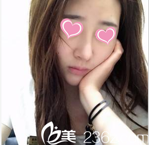 <!--<i data=20240703-sp></i>-->鼻綜合案例術(shù)后35天樣子 <!--<i data=20240703-sp></i>-->鼻綜合案例術(shù)后35天樣子