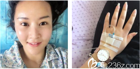 找廣州華美郝永生做完脂肪填充和面部吸脂第二天 找廣州華美郝永生做完脂肪填充和面部吸脂第二天