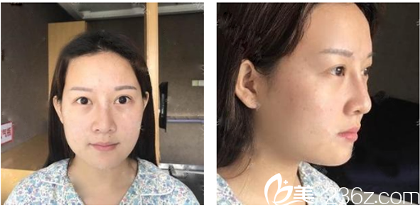 來(lái)廣州華美做自體脂肪面部填充前的照片 來(lái)廣州華美做自體脂肪面部填充前的照片