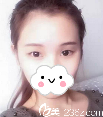 單眼皮的我 單眼皮的我