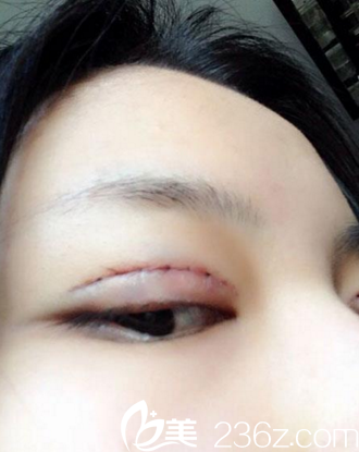 術(shù)后當天下午 術(shù)后當天下午