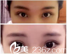 手術(shù)后第五天 手術(shù)后第五天