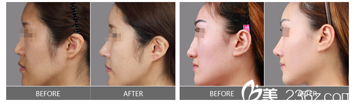 <!--<i data=20240703-sp></i>-->假體隆鼻案例