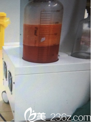 吸出來(lái)的脂肪 吸出來(lái)的脂肪