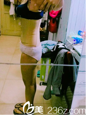 <!--<i data=20240703-sp></i>-->整形腰腹吸脂術(shù)后第五天 <!--<i data=20240703-sp></i>-->整形腰腹吸脂術(shù)后第五天