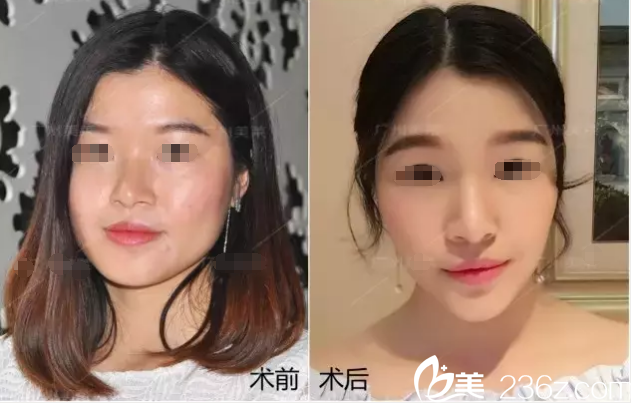 面部注射玻尿酸案例