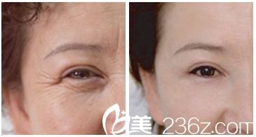 激光除皺術(shù)前術(shù)后對(duì)比案例