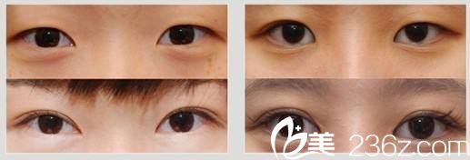 雙眼皮術(shù)前術(shù)后對(duì)比案例 雙眼皮術(shù)前術(shù)后對(duì)比案例