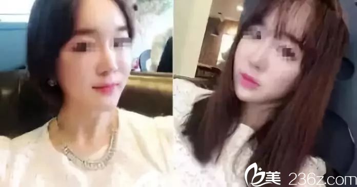 在鎮(zhèn)江采薇注射2支伊婉玻尿酸填充面部?jī)H3天，就能明顯的看到法令紋和淚溝都沒(méi)有了