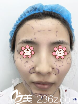 去重慶銅雀臺(tái)整形醫(yī)院面診的我 去重慶銅雀臺(tái)整形醫(yī)院面診的我