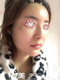 <!--<i data=20240703-sp></i>-->自體脂肪填充額頭術(shù)后4天 <!--<i data=20240703-sp></i>-->自體脂肪填充額頭術(shù)后4天