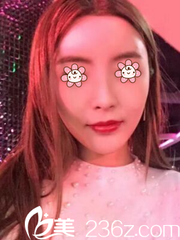 重慶銅雀臺(tái)整形自體脂肪豐太陽穴術(shù)后8天 重慶銅雀臺(tái)整形自體脂肪豐太陽穴術(shù)后8天