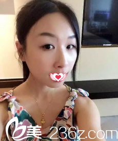 術(shù)前單眼皮 術(shù)前單眼皮