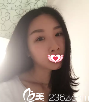 術(shù)后7天雙眼皮拆完線的樣子 術(shù)后7天雙眼皮拆完線的樣子