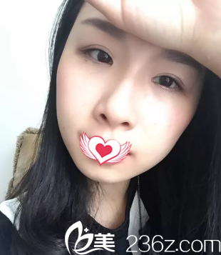 15天雙眼皮恢復(fù)的款窄適中 15天雙眼皮恢復(fù)的款窄適中