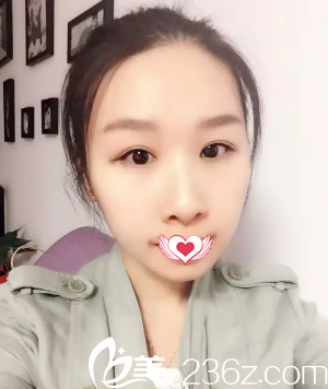 還在糾結(jié)去或者美天做雙眼皮手術(shù)?反正我已經(jīng)找孫喜平醫(yī)生做切開雙眼皮美了5年