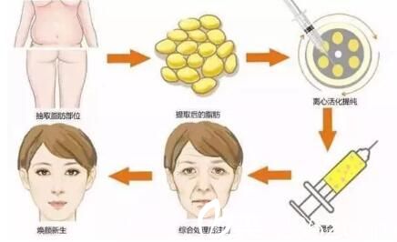 南寧華美自體脂肪面部填充 南寧華美自體脂肪面部填充