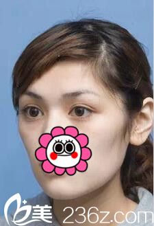 南寧華美面部填充整形案例術(shù)前 南寧華美面部填充整形案例術(shù)前