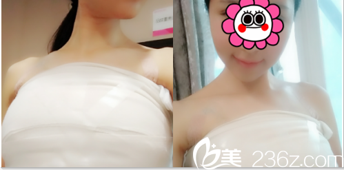 北京美萊假體隆胸案例術(shù)后第4天效果