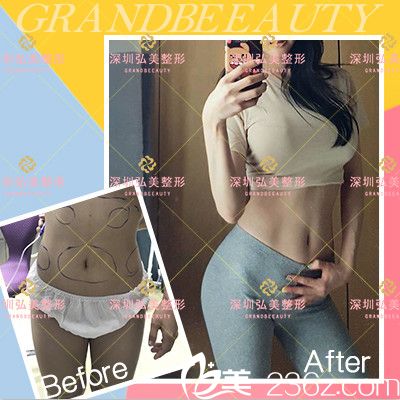 深圳弘美醫(yī)療美容整形醫(yī)院腰腹部吸脂案例圖