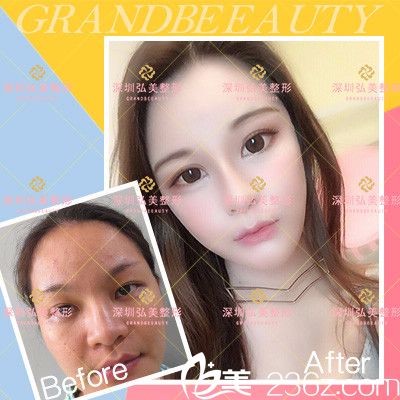 深圳弘美醫(yī)療美容整形醫(yī)院鼻綜合隆鼻案例效果圖