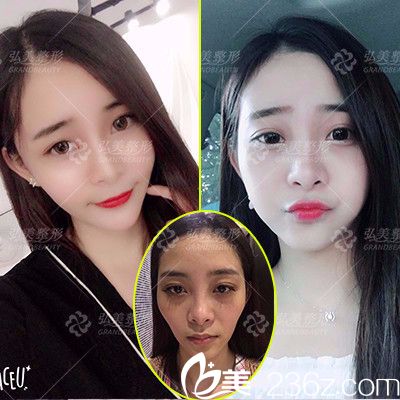 深圳弘美醫(yī)療美容整形醫(yī)院自體脂肪全臉填充案例