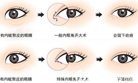 大同美神整形美容診所開眼角科普圖